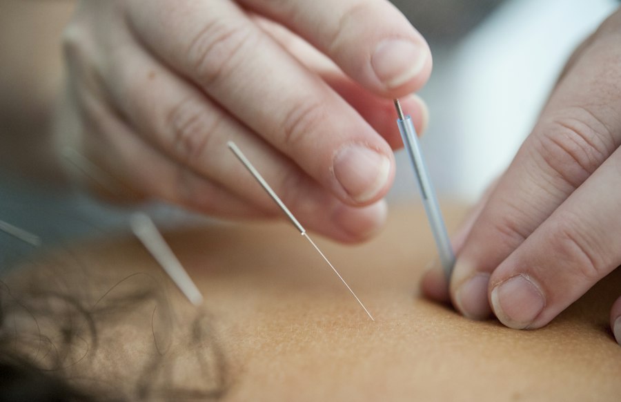 Fine acupuncture needles being placed in a patient's back